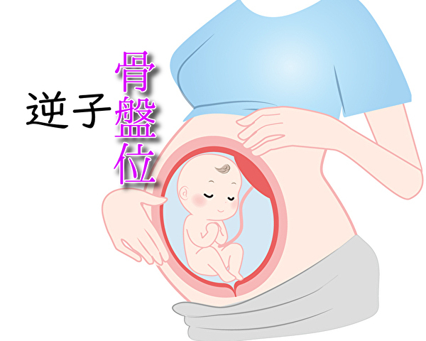逆子（骨盤位）